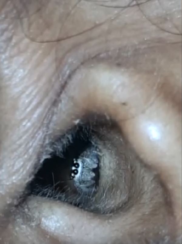 selalu sakit kepala, bila check ada labah-labah masih hidup dalam telinga