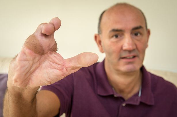 pindah jari kaki ke tangan supaya boleh belajar menulis semula