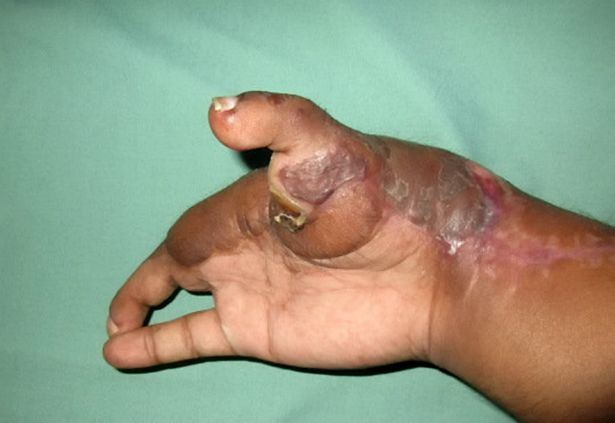 tiada pilihan, doktor gantikan jari tangan yang hilang dengan jari kaki