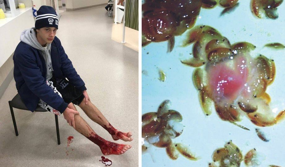 puluhan lubang kecil pada kaki remaja disebabkan kutu air