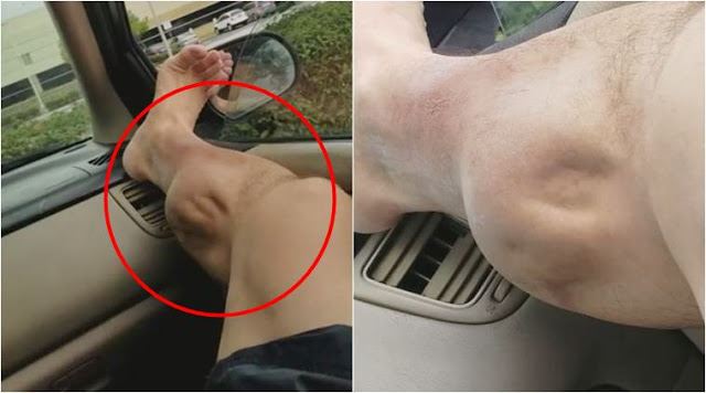 apa nak buat kalau kaki kena cramp macam ni ?