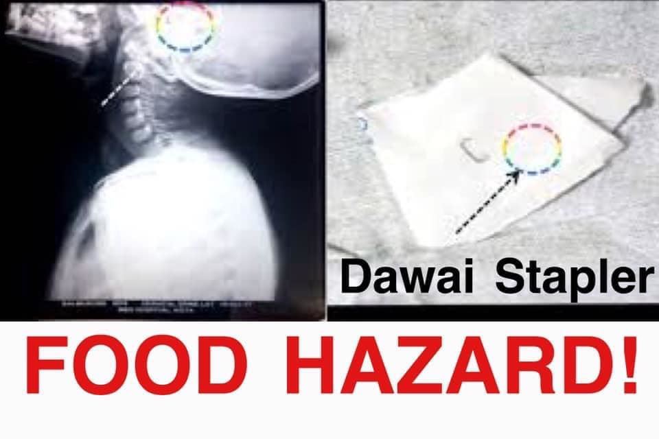 budak bengkak gusi rupanya tergigit dawai stapler dari makanan