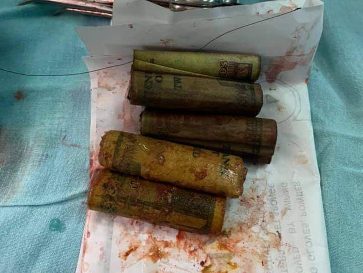 duit kertas, paku dan pemetik api ditemui dalam perut lelaki ini