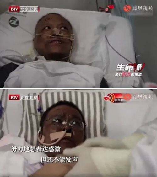 dua doktor china bertukar warna kulit selepas dijangkiti covid-19