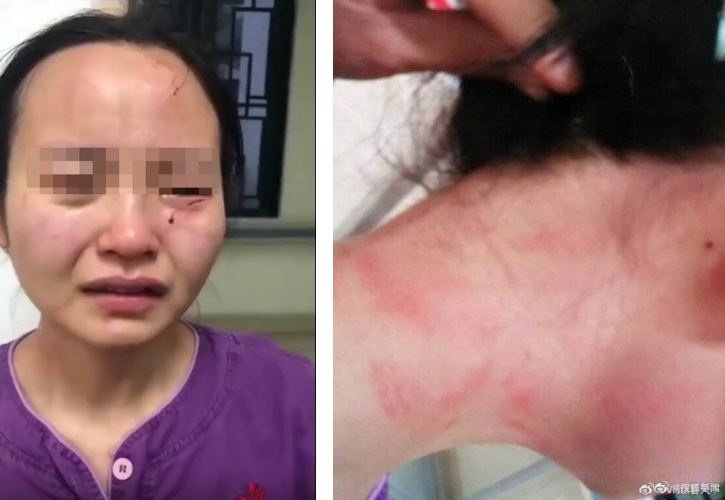 lelaki positif covid-19 tergamak gigit jururawat sebab tak mahu buat ujian darah