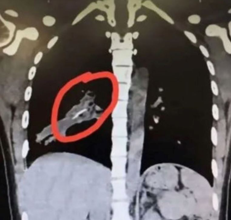 batuk tak henti selama 14 tahun rupanya ada tulang ayam tersekat