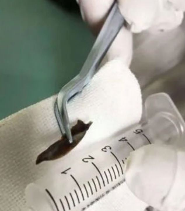 batuk tak henti selama 14 tahun rupanya ada tulang ayam tersekat