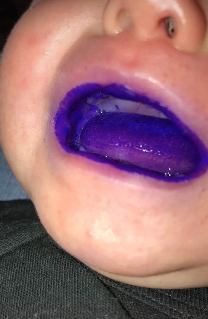 didakwa telan pen sharpie, ibu jelaskan kenapa mulut bayi warna ungu