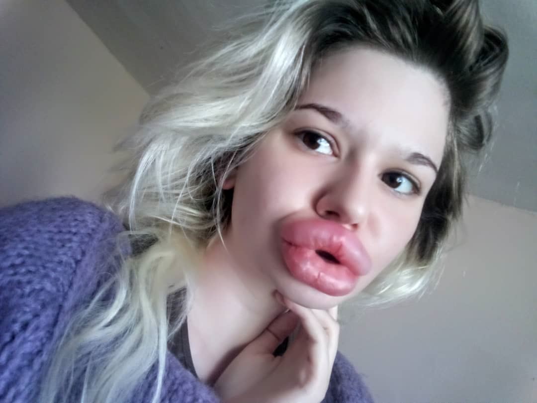 sanggup tanggung risiko demi miliki bibir terbesar di dunia