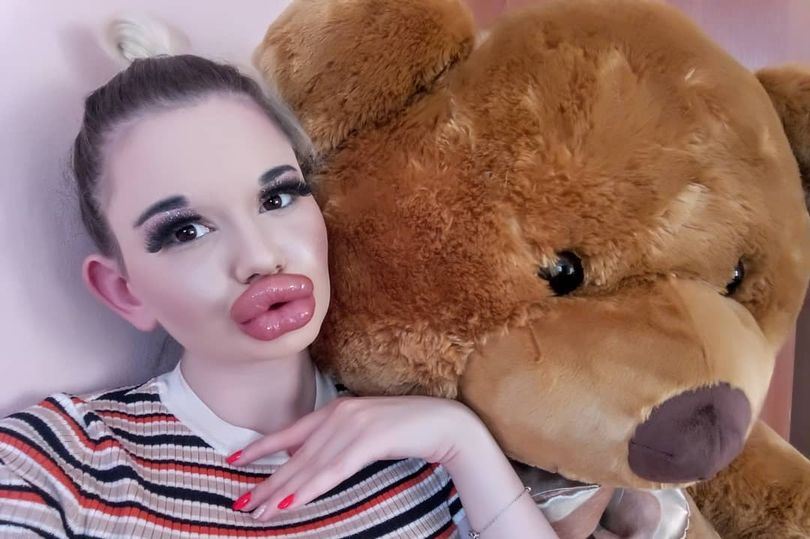 sanggup tanggung risiko demi miliki bibir terbesar di dunia