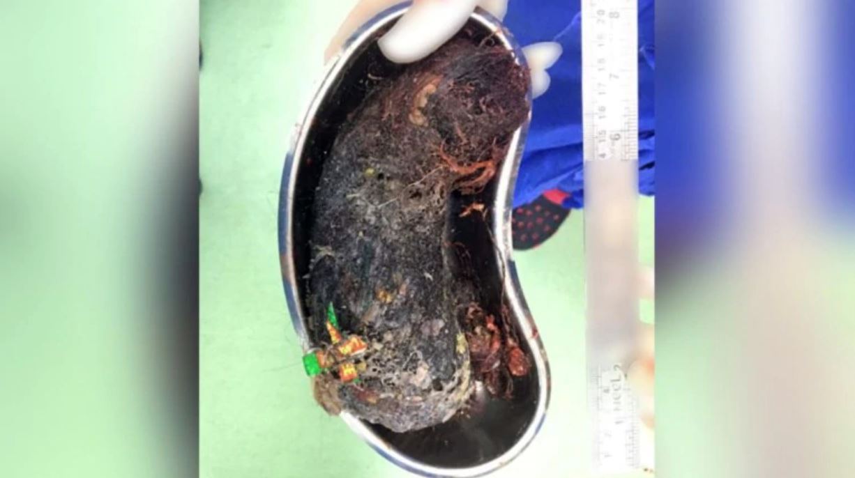 remaja perempuan tertekan ada tabiat pelik suka telan rambut sendiri