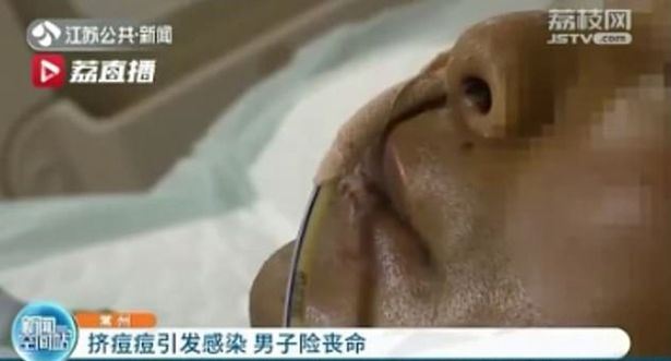 lelaki hampir maut lepas picit jerawat pada dagu, ‘‘mulutnya bengkak dan badan panas..’’