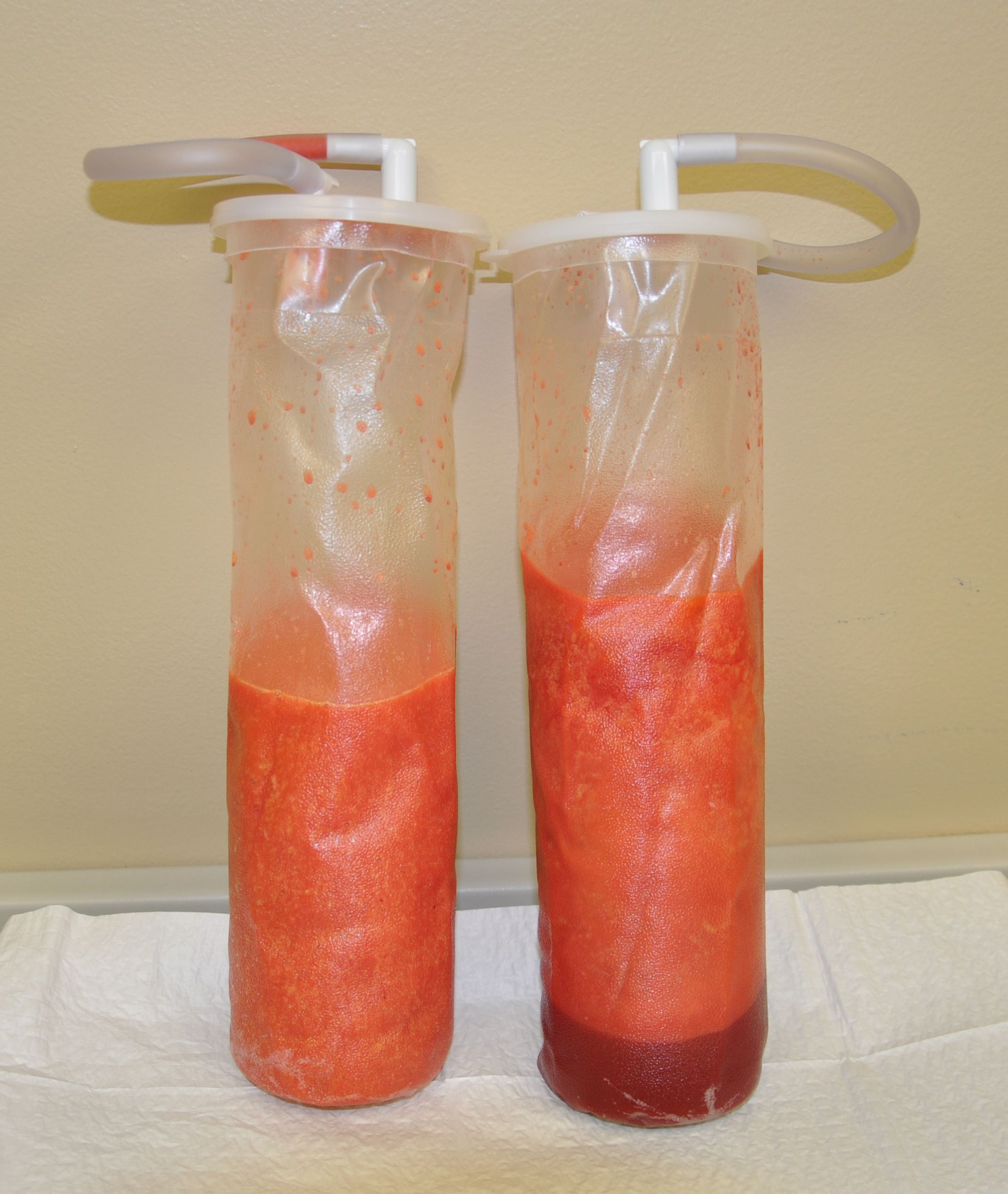 sedut lemak untuk kurangkan berat badan adalah mitos