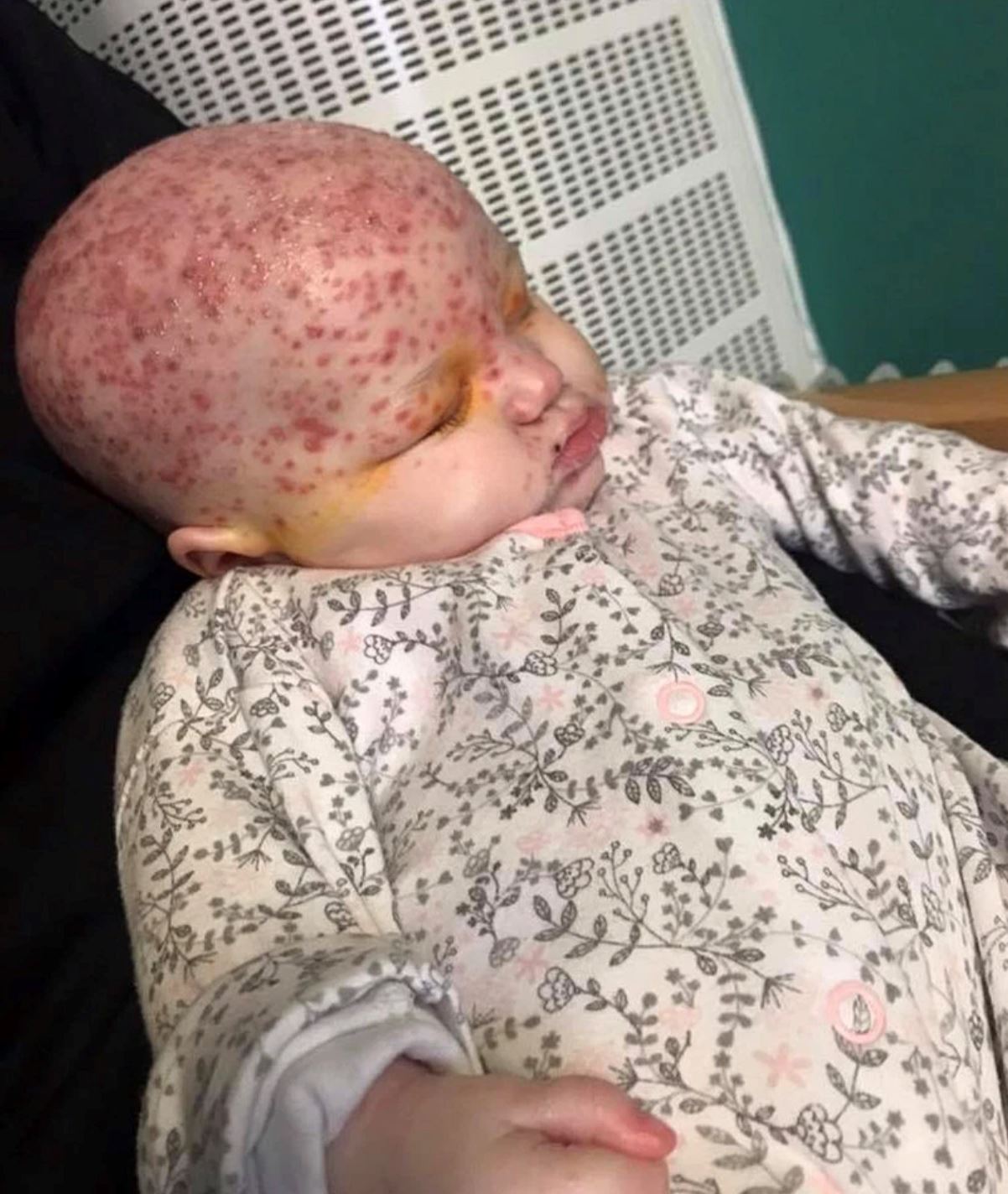 bayi enam bulan sengsara jangkitan virus herpes lepas dicium dan disentuh orang ramai