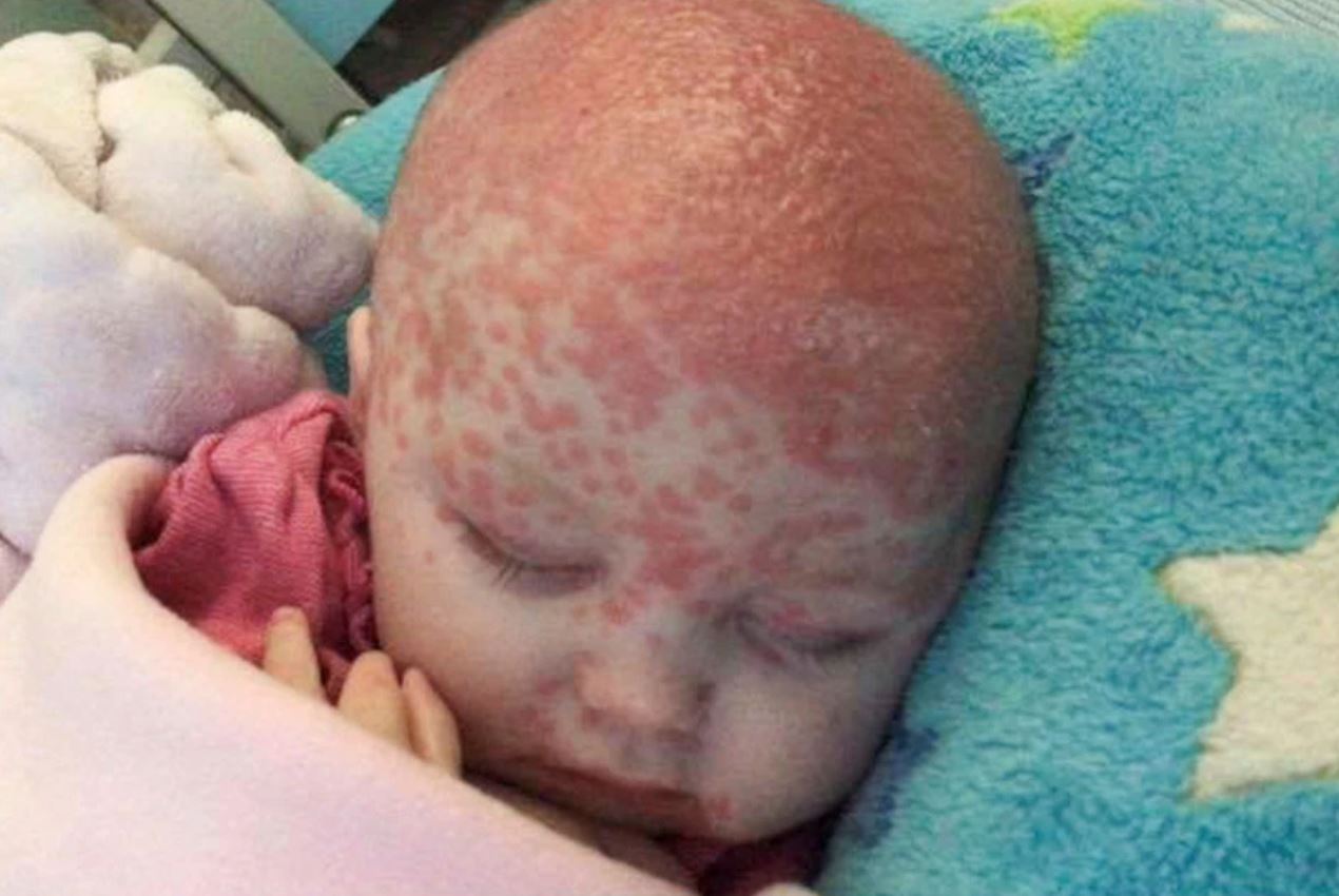 bayi enam bulan sengsara jangkitan virus herpes lepas dicium dan disentuh orang ramai