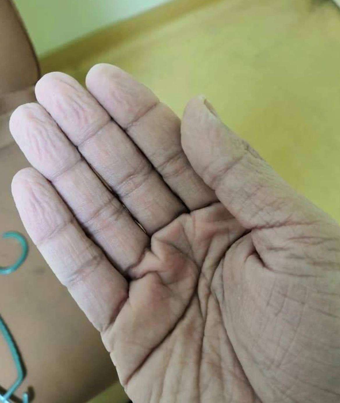 sampai berbekas muka nurse seharian pakai face mask berperang dengan covid-19