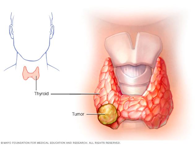 penonton tegur benjolan pada leher, wartawan ini baru tahu ada kanser