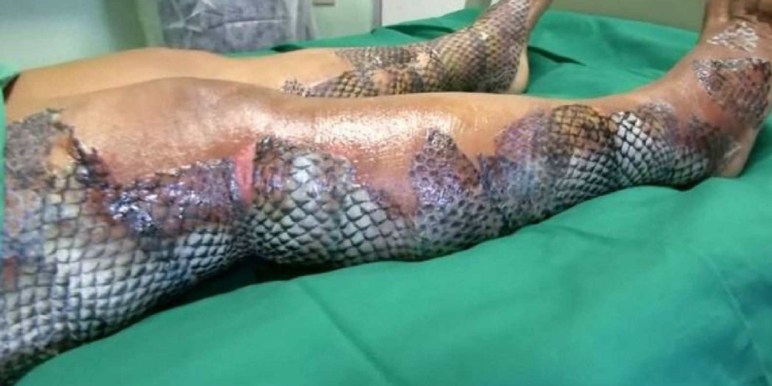 betul ke ikan tilapia boleh sembuhkan luka terbakar pada kulit?