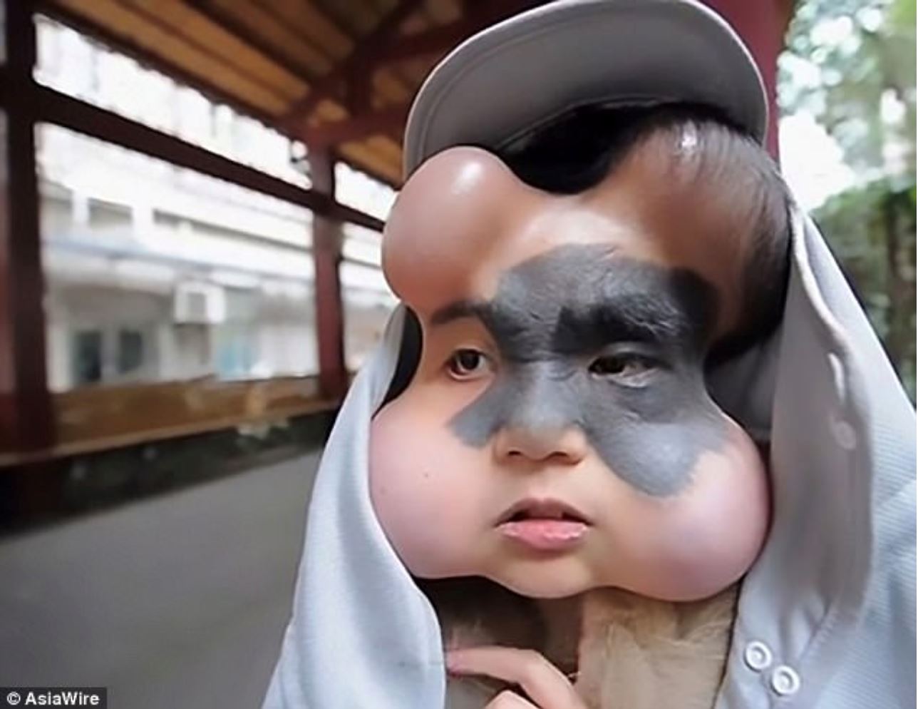 nak buang kanser, doktor kena tanam 4 belon bawah muka gadis ini