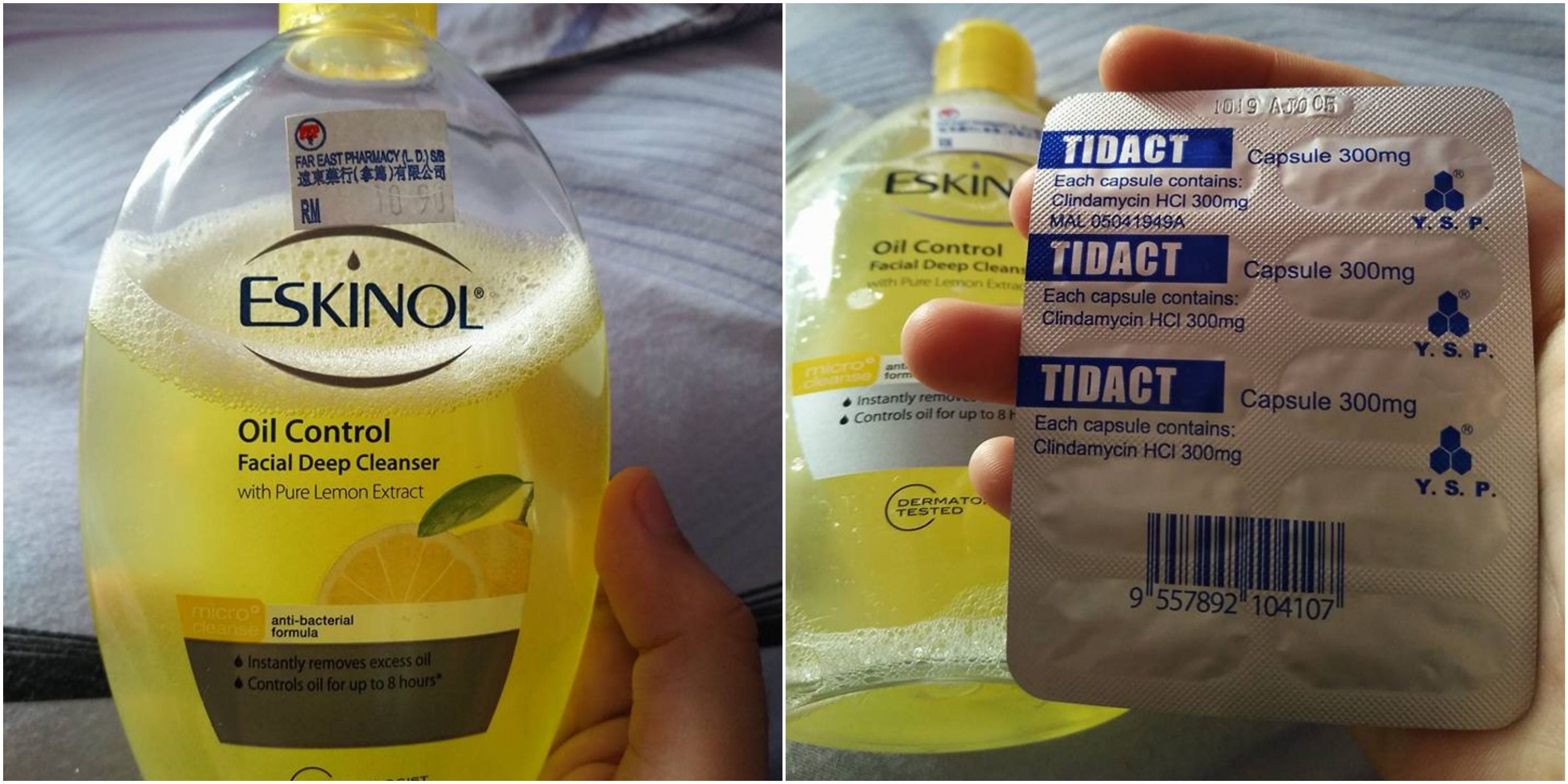 cara hilangkan jerawat batu guna eskinol lemon dan anti bakteria jadi viral