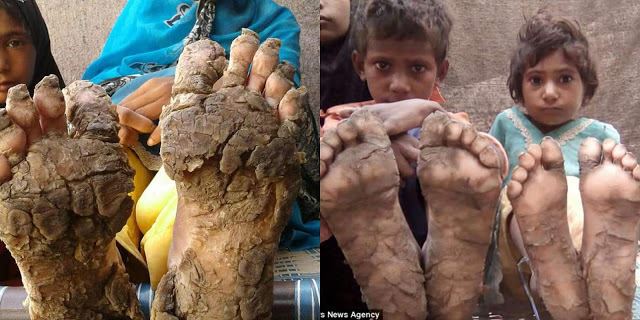 derita empat beradik, kaki bertukar keras seperti batu