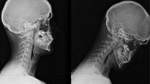 Setiap Kali Scroll Media Sosial, Leher Anda Menanggung 12kg Beban, Awas Sindrom Text Neck!