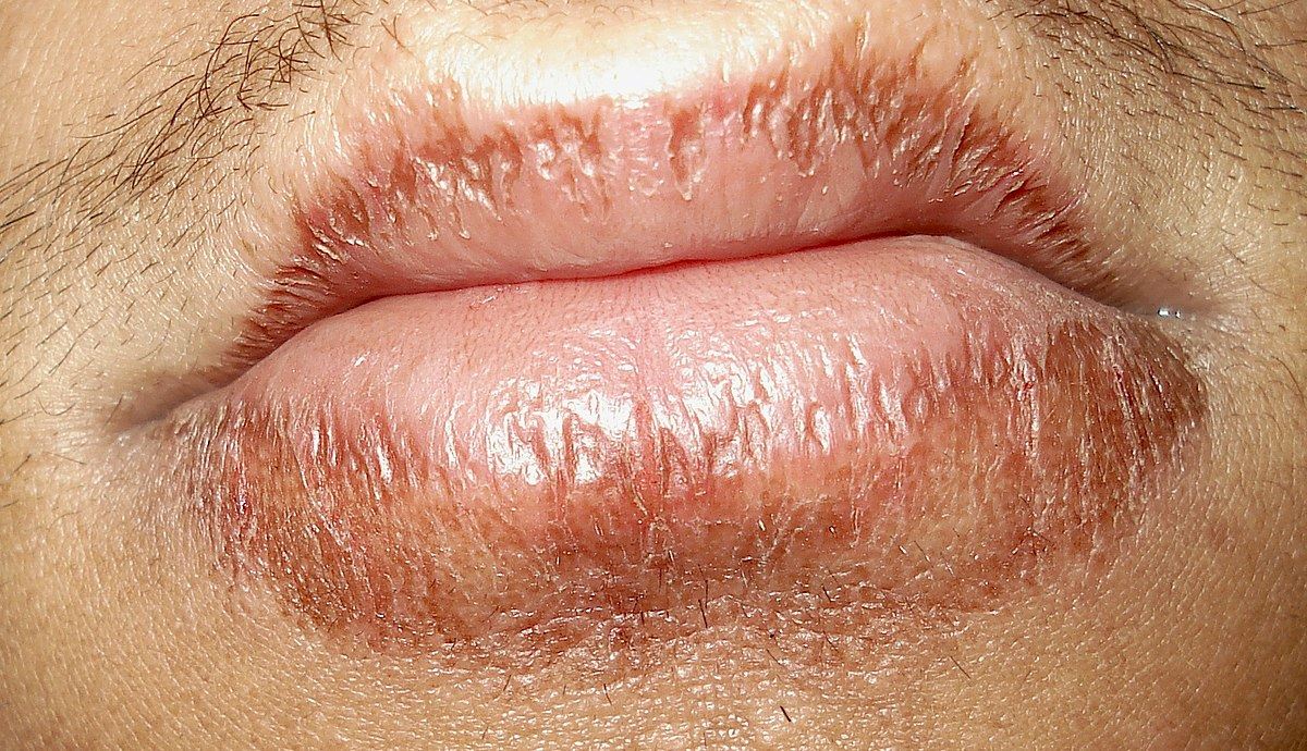 ini 7 perkara yang jadi punca kenapa bibir kita kering dan merekah