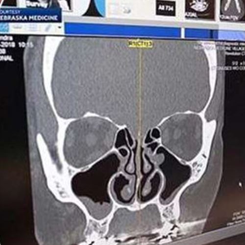 lima tahun hingus mengalir, rupanya ada kebocoran cecair dalam otak
