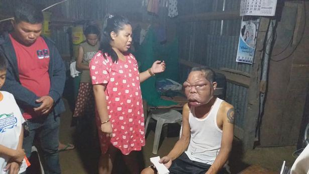 hidap penyakit misteri, wajah lelaki ini berubah mirip shin chan