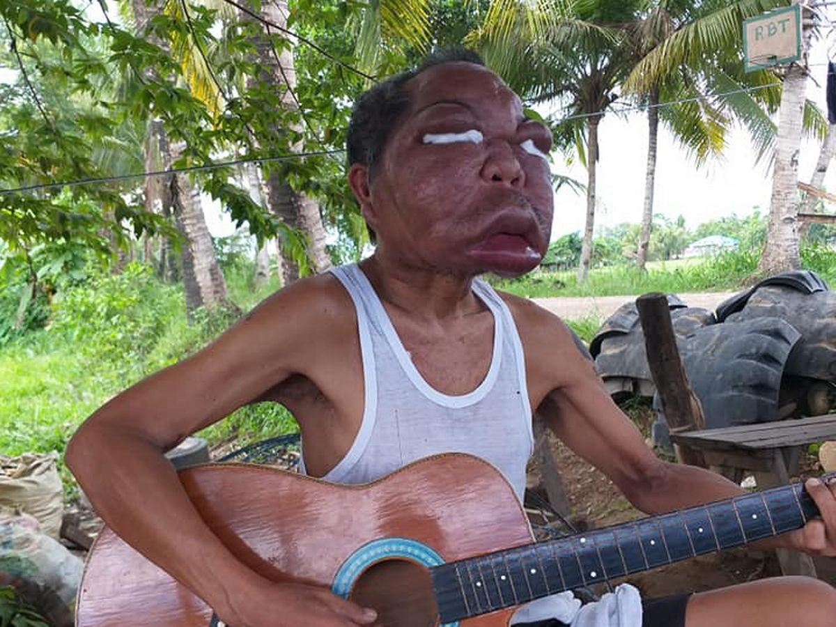 hidap penyakit misteri, wajah lelaki ini berubah mirip shin chan