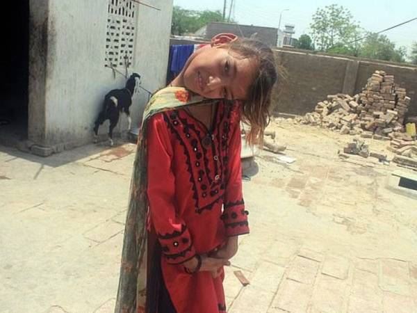 kanak-kanak ini hidup dengan kepala bongkok 90 darjah