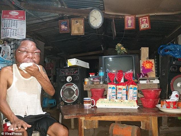 hidap penyakit misteri, wajah lelaki ini berubah mirip shin chan