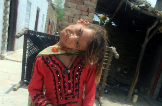 kanak-kanak ini hidup dengan kepala bongkok 90 darjah