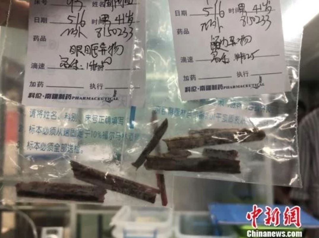 doktor jumpa longgokan kayu dalam otak lelaki yang selalu sakit kepala