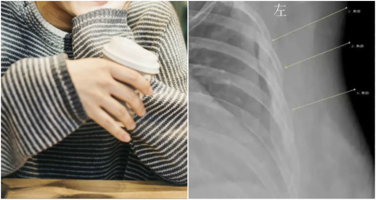 patah tulang rusuk akibat selalu minum kopi