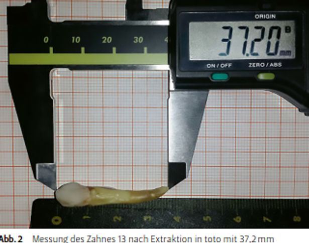 pecah rekod dunia, doktor gigi teruja berjaya cabut gigi manusia paling panjang