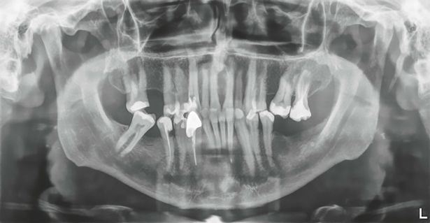 pecah rekod dunia, doktor gigi teruja berjaya cabut gigi manusia paling panjang