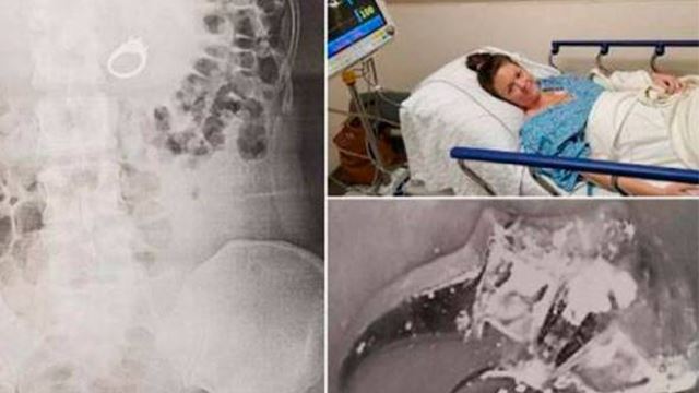 takut sebab mimpi orang jahat, wanita ini tertelan cincin tunang masa tidur