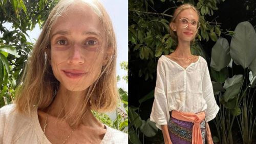 Obsesi Diet Ekstrem Ragut Nyawa, Wanita Meninggal Dunia Akibat Kekurangan Zat
