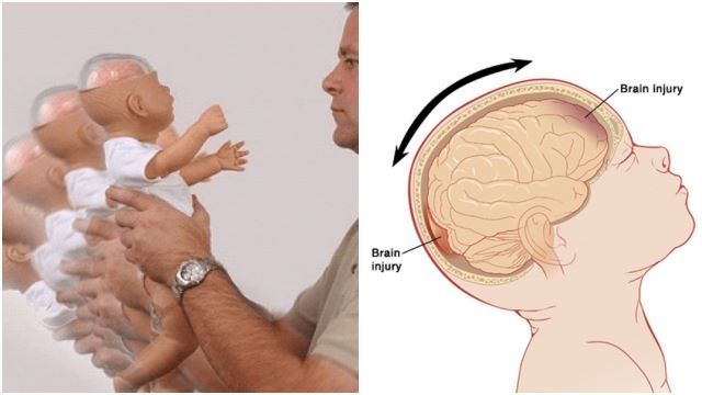 Perbuatan Melambung Bayi Boleh Sebabkan Otak Bengkak