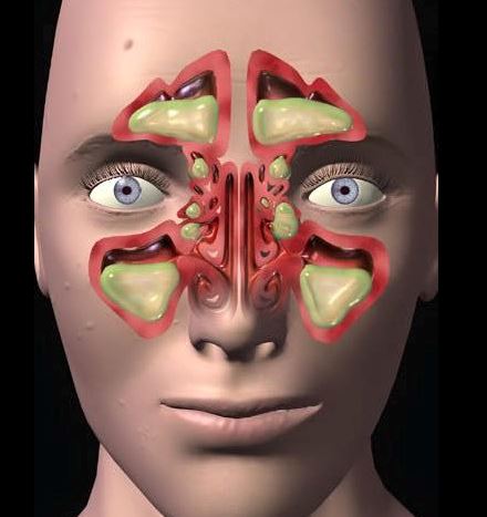 5 tips mudah hilangkan resdung