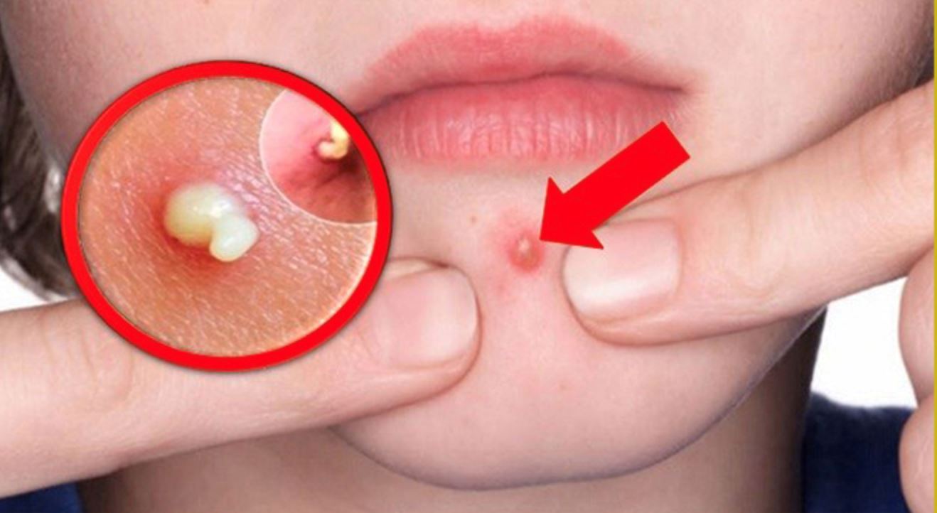 apa sebenarnya warna putih yang keluar dari jerawat tu?