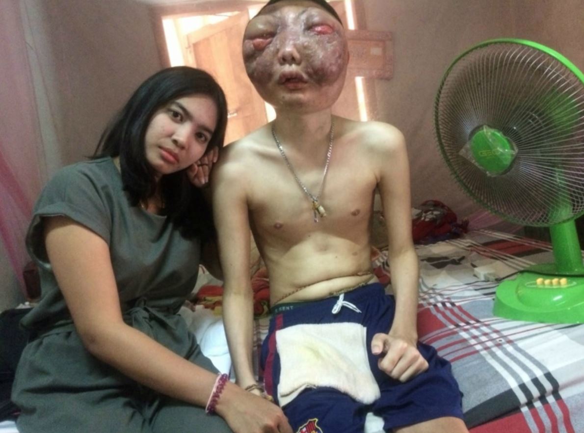 mengharukan! wanita ini kekal setia bersama teman lelaki yang menghidap kanser mata tahap akhir..