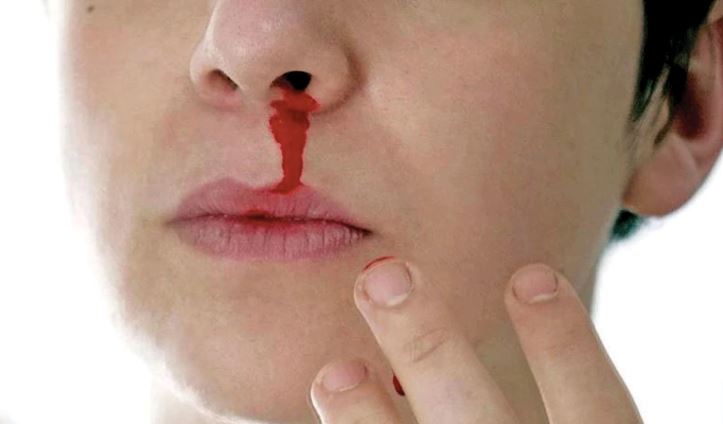 jangan mendongak bila hidung berdarah ! cara betul adalah dengan melakukan 7 step ini