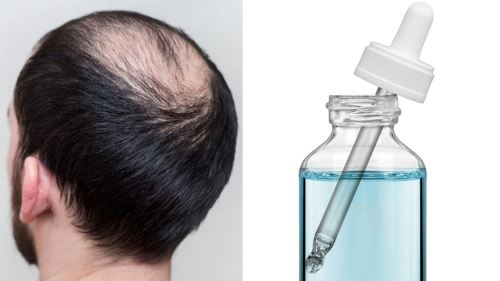Saintis Temui Serum Ajaib Tumbuhkan Rambut Dalam 20 Hari, Tak Perlu Tanam Rambut Lagi!