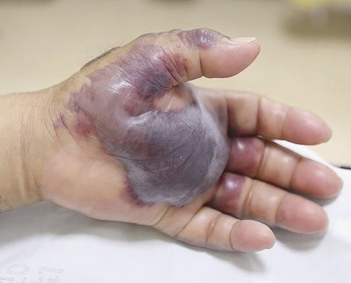 tangan lelaki ini terpaksa dipotong selepas makan sushi