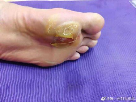 中国男单「谌龙」带伤打赛!脚底血泡把网民吓着!