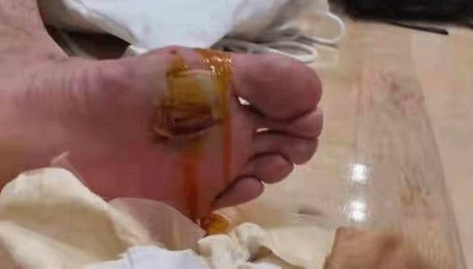 中国男单「谌龙」带伤打赛!脚底血泡把网民吓着!