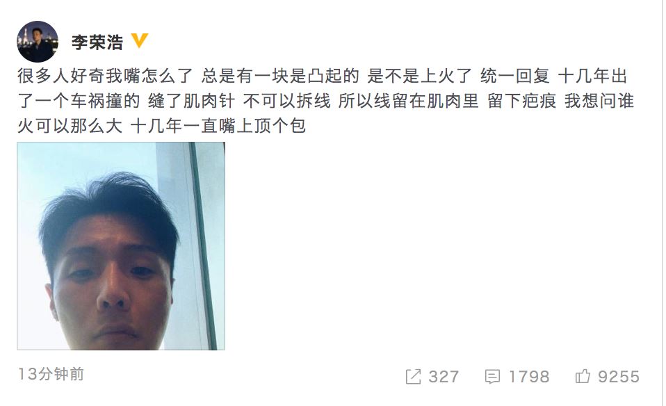 李荣浩嘴上异状凸起:十几年前车祸留疤所致
