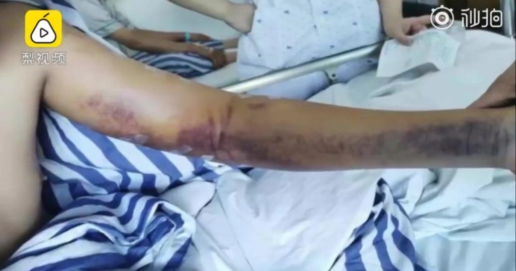 college student breaks and bruises his arm after an arm-wrestling match